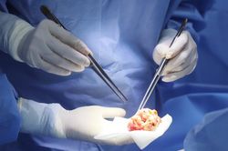 Nguy cơ co thắt bao xơ sau nâng ngực