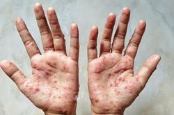 Kết quả giải mã gene ca đậu mùa khỉ ở TP HCM