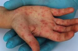 Đã có kết quả giải mã gene ca đậu mùa khỉ nội địa đầu tiên ở TPHCM