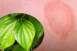 Trị hắc lào bằng thảo dược tại nhà