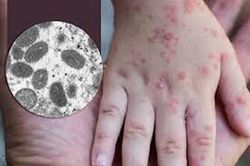 TPHCM: Phát hiện ca bệnh đậu mùa khỉ thứ 5