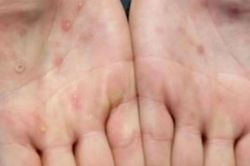 Nhóm người nào có nguy cơ cao mắc bệnh đậu mùa khỉ?
