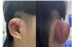 Bác sỹ cảnh báo hiểm họa khôn lường từ việc xỏ lỗ trên vành tai