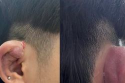 Hoại tử, áp xe vành tai do sở thích xâu nhiều khuyên tai ở giới trẻ