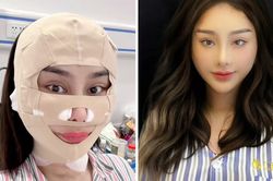 Lâm Khánh Chi kể tường tận quá trình căng da mặt, dân mạng nghe mà 'hết hồn'