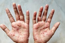 TP Hồ Chí Minh đã có 13 ca bệnh đậu mùa khỉ