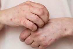 Thêm 4 ca đậu mùa khỉ trong một ngày ở TP HCM