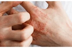 Viêm da cơ địa dùng thuốc gì để giảm ngứa?