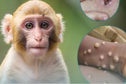 Phát hiện ca mắc đậu mùa khỉ mới tại Long An