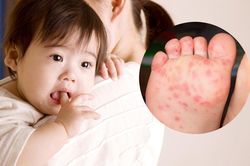 Hà Nội xuất hiện ổ dịch tay chân miệng tại trường học, lưu ý cần biết để phòng bệnh cho trẻ