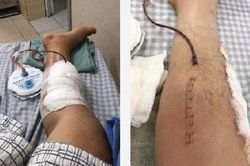 Tự ý dùng thuốc Đông - Tây y kết hợp, bệnh nhân trẻ tuổi suýt hoại tử chân