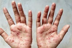 Đồng Nai: Xuất hiện ca đậu mùa khỉ thứ 2