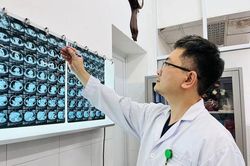 Cắt thành công bướu giáp khổng lồ nằm sâu trong lồng ngực cụ bà gần 90 tuổi
