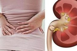 Suýt mất mạng vì bị sỏi thận sau 1 năm tự uống thuốc nam tại nhà