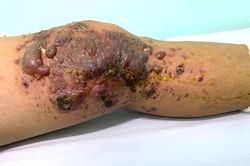 Khuyến cáo về việc chữa bệnh bằng phương pháp đắp, bó lá tại nhà