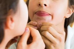Mất mạng vì... nặn mụn?