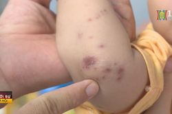 Không thiếu thuốc điều trị tay chân miệng