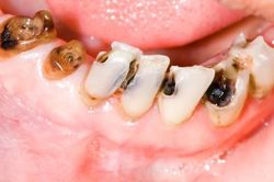 5 dấu hiệu cảnh báo sâu răng và cách phòng ngừa