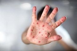 TPHCM ghi nhận ca tử vong đầu tiên liên quan bệnh đậu mùa khỉ
