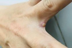 Diễn biến bệnh của ca mắc đậu mùa khỉ đầu tiên tử vong ở Việt Nam