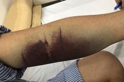Nguy hiểm khi người tiểu đường mắc sốt xuất huyết