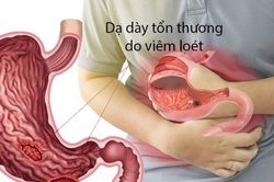 Căng thẳng dễ gây đau bụng, đau dạ dày