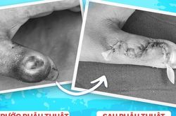 Hoại tử ngón tay do tự ý đắp thuốc lá của thầy lang