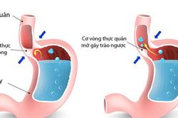 Bệnh trào ngược dạ dày - thực quản: 5 biến chứng nguy hiểm