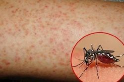Cảnh báo biến chứng cô đặc máu khi mắc sốt xuất huyết