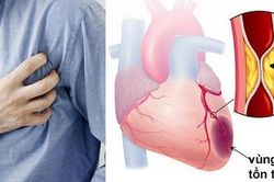 4 yếu tố gây nhồi máu cơ tim cấp cần lưu ý