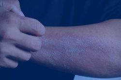 Tái phát viêm da cơ địa khi thay đổi thời tiết: Làm gì để phòng ngừa?