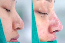 Biến chứng nặng sau nâng mũi phong thủy