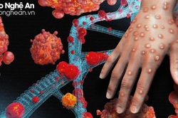Bệnh đậu mùa khỉ và những nguy cơ cao với người có HIV