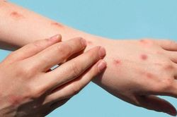 Nhận biết bệnh đậu mùa khỉ bằng cách nào?