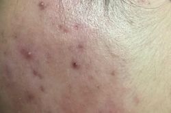 Chăm sóc da như thế nào để ngăn ngừa mụn trứng cá ở tuổi dậy thì?