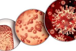 Bệnh đậu mùa khỉ và những nguy cơ cao với người có HIV