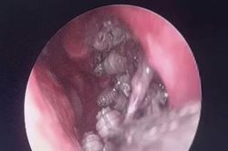 Bệnh viện Đa khoa tỉnh cấp cứu bệnh nhân nam bị giòi làm tổ trong hốc mũi