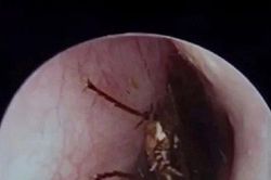 Bé bị gián bò vào tai, mẹ xử lý cách này được bác sĩ khen ngợi hết lời