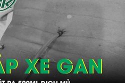 Áp xe gan hút ra 500ml dịch mủ