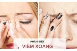 Phân biệt viêm xoang và viêm mũi dị ứng, cách phòng bệnh