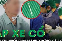 Mảnh xương 1cm 'ẩn nấp' trong món cá khiến cụ ông phải phẫu thuật cấp cứu