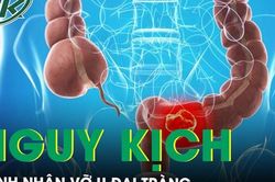 Bụng chướng nhiều, đau dữ dội vào viện phát hiện vỡ u đại tràng