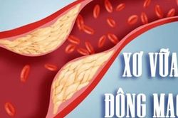 8 cách giúp phòng xơ vữa động mạch, ngăn ngừa đột quỵ