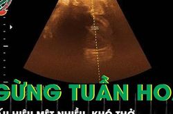 Mệt nhiều, khó thở bệnh nhân nguy kịch ngừng tuần hoàn do rối loạn nhịp tim