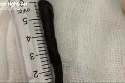 Gắp con đỉa dài hơn 6 cm ra khỏi khí quản bệnh nhân