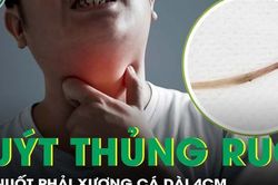 Người đàn ông suýt thủng dạ dày vì nuốt phải xương cá dài 4cm