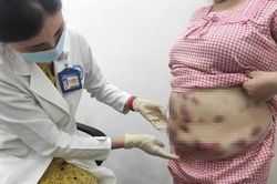 Nhiều tai biến, biến chứng sau thẩm mỹ