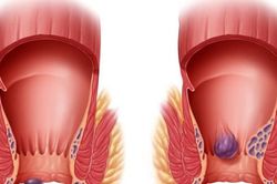 Bị trĩ có cần phải phẫu thuật?