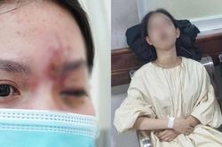 Tình trạng sức khỏe hiện tại của nữ sinh 17 tuổi bị mù mắt vì tiêm filler ở tiệm cắt tóc, gội đầu