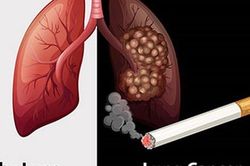 Chồng hút thuốc lá vợ lại mắc ung thư phổi, chuyên gia ung thư nói gì?